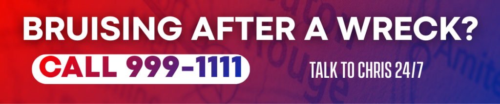 Wide promotional banner with bold text that reads “Bruising After a Wreck?” followed by “Call 999-1111.” Smaller text says “Talk to Chris 24/7.” The graphic uses red, purple, and blue tones and promotes immediate legal help after a car accident.